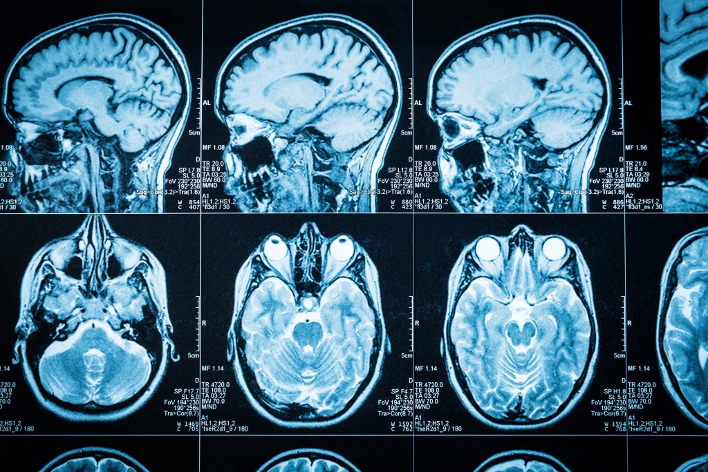 <span class="entry-title">Multiple Sclerosis Pilot Study Evaluating PoNS Yields Promising Results</span><span class="entry-subtitle">PoNS found to improve brain function, neural plasticity and balance in MS patients</span>