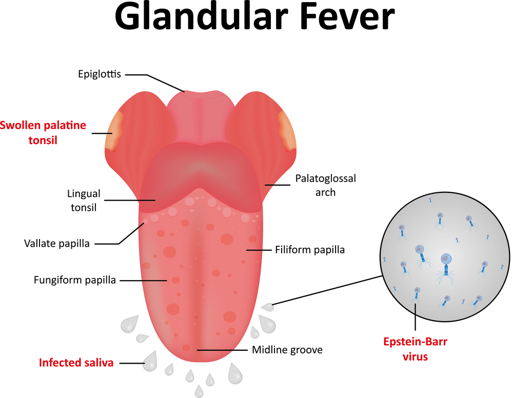 Recurrent Tonsillitis After Glandular Fever