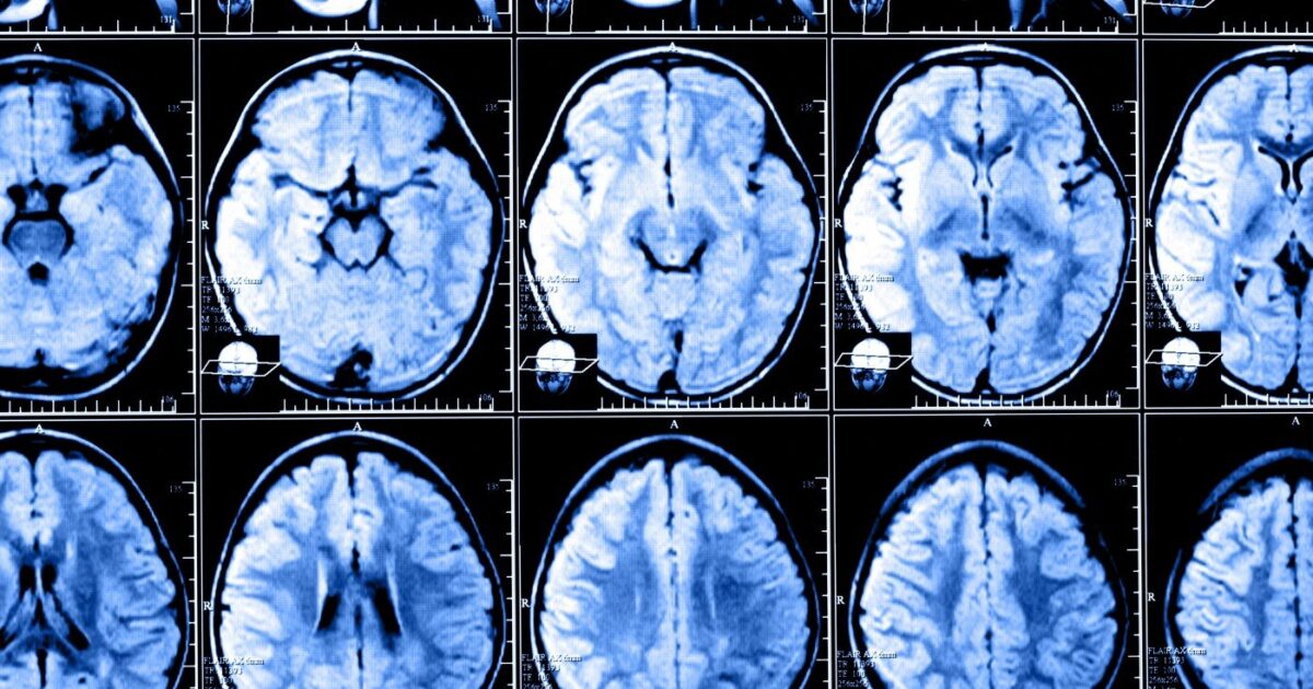 Some MS Patients Show No Link Between Clinical Exams And MRIs Harvard