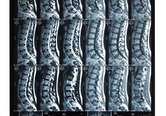 Case Study Highlights Demyelinating Lesion in Pediatric MS Patient Discovered After Abdominal Pain