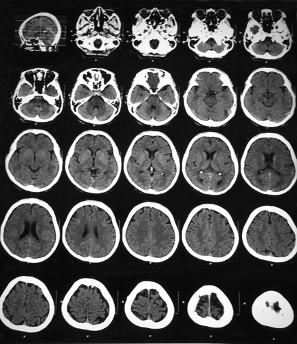 Cognitive Decline