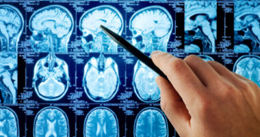 A hand holding a pen points to a brain MRI scan among several rows of brain images displayed on a screen.