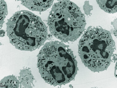 cell transplant for RRMS
