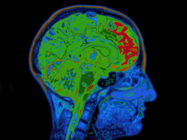 MS brain scan