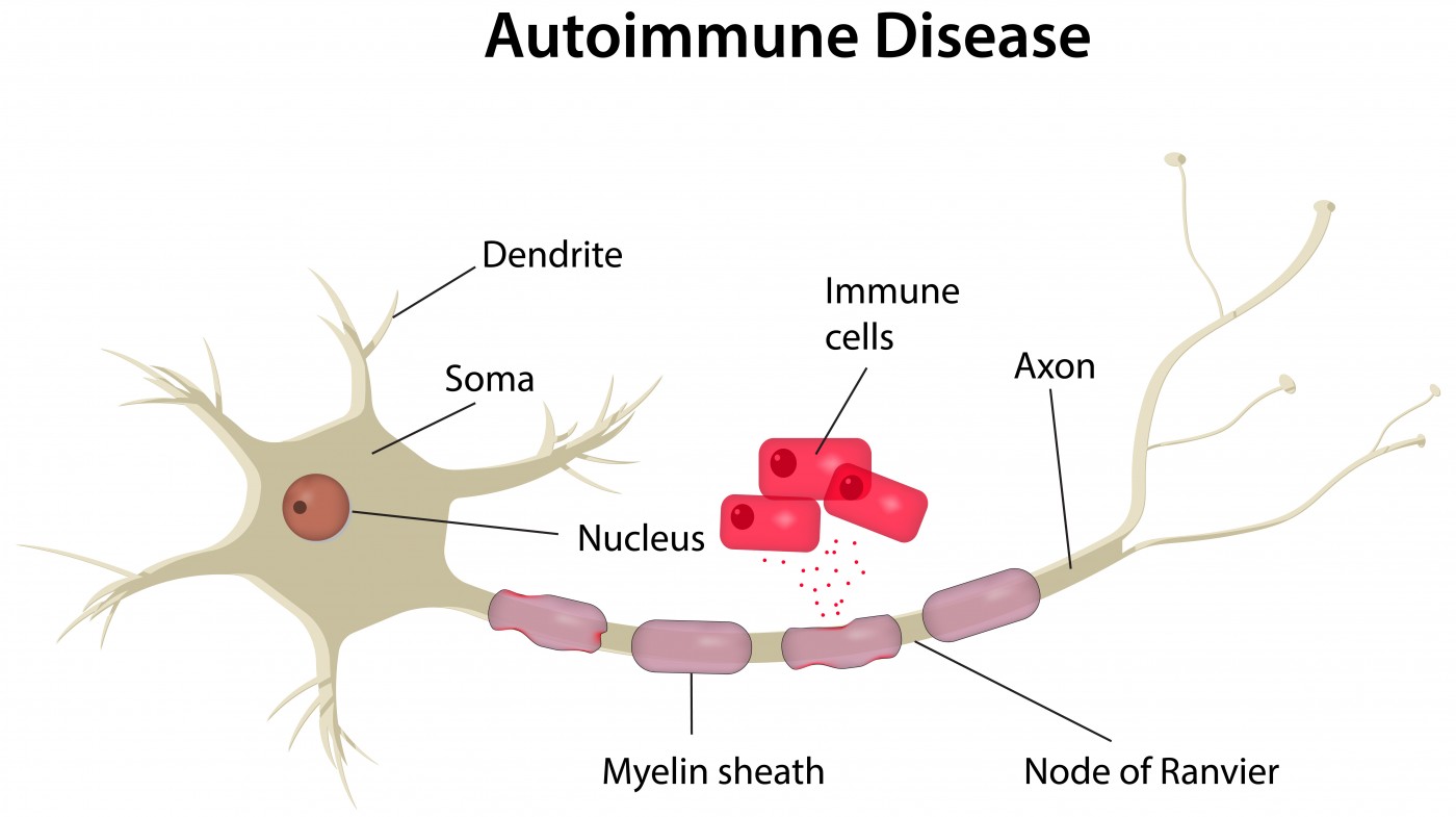 multiple sclerosis study