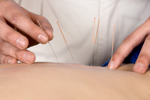acupuncture and MS