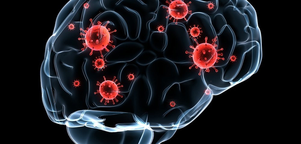 What Are The Signs Of A Brain Infection? – JRAU