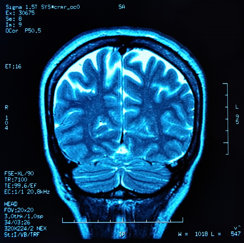 Autoimmune diseases and MS brain injury