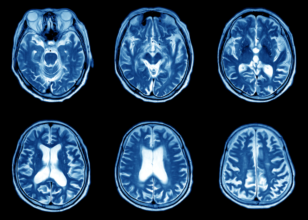 brain atrophy and MS