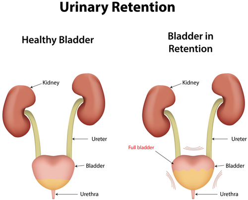 urine retention causes)