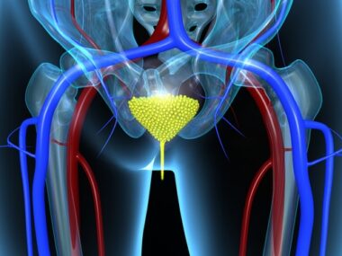 Neurogenic Detrusor Overactivity and MS