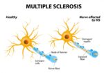 MS and seizures