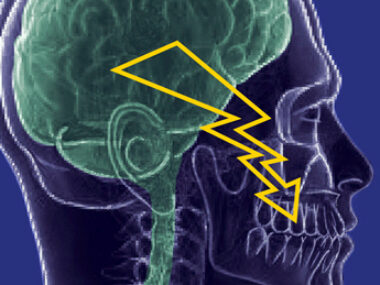 trigeminal neuralgia