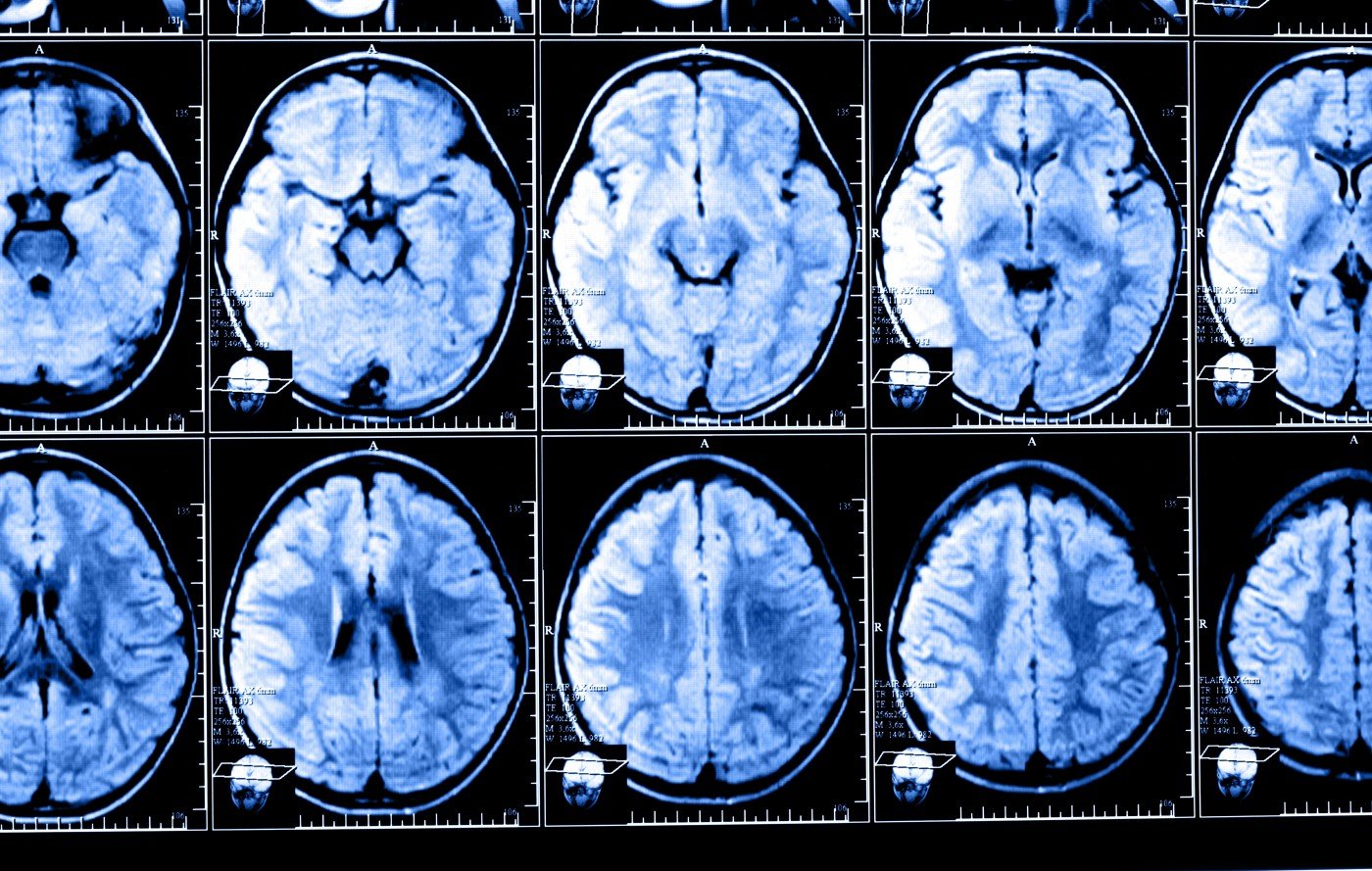 MS brain scans
