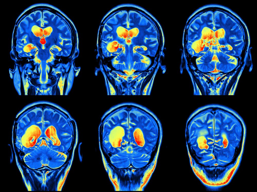 normal brain mri with contrast