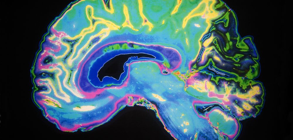 Concussion in Adolescence May Increase Risk of MS Later, Swedish Study Suggests Concussion in Adolescence May Increase Risk of MS Later, Swedish Study Suggests