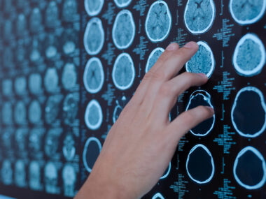 myelin repair, diagnosis