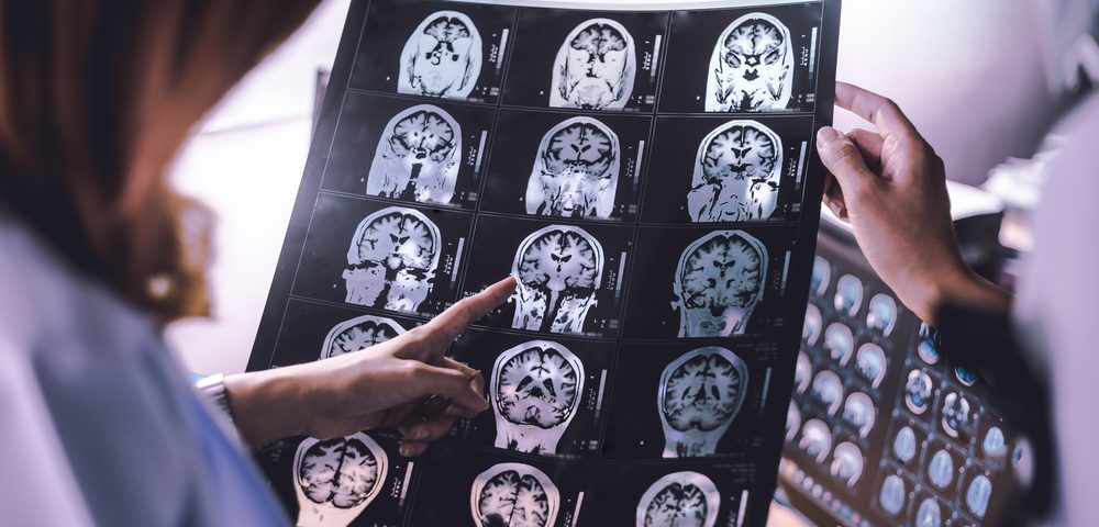 Social Cognition Issues Linked to Damage in Specific Brain Region in RRMS Patients, Study Shows Social Cognition Issues Linked to Damage in Specific Brain Region in RRMS Patients, Study Shows