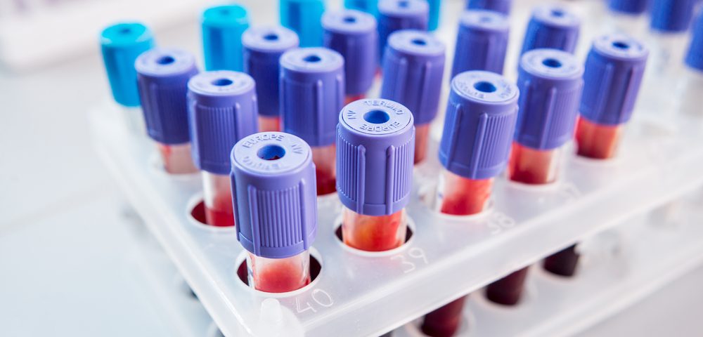 University of Huddersfield Team Develops Blood Test for Diagnosing MS University of Huddersfield Team Develops Blood Test for Diagnosing MS