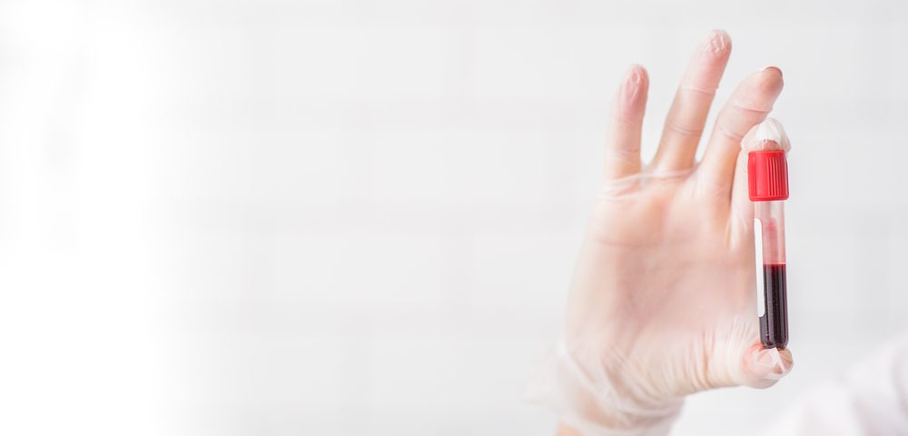 Levels of Nerve Protein in Blood Provide Good Grasp of MS Activity, Study Finds Levels of Nerve Protein in Blood Provide Good Grasp of MS Activity, Study Finds