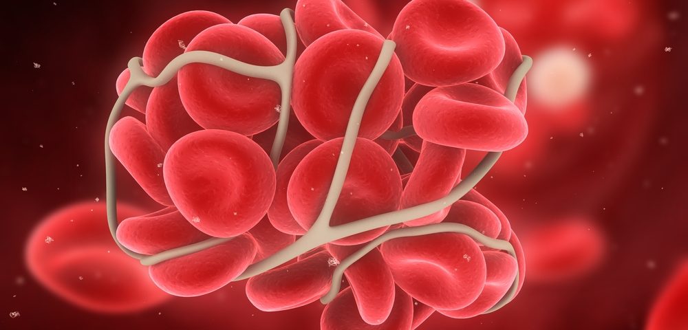 Measuring Blood Clotting Factor Could Pinpoint RRMS Patients at Risk for Heart Disease Measuring Blood Clotting Factor Could Pinpoint RRMS Patients at Risk for Heart Disease