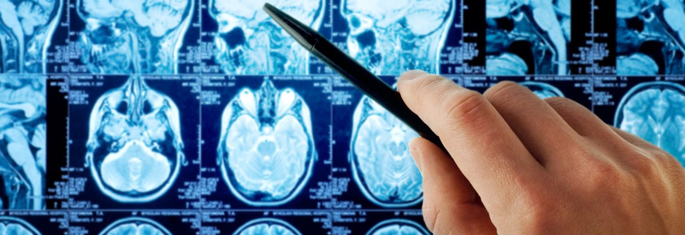 Grey Matter Atrophy Common to All with MS and Follows Ordered Sequence, Study Finds Grey Matter Atrophy Common to All with MS and Follows Ordered Sequence, Study Finds