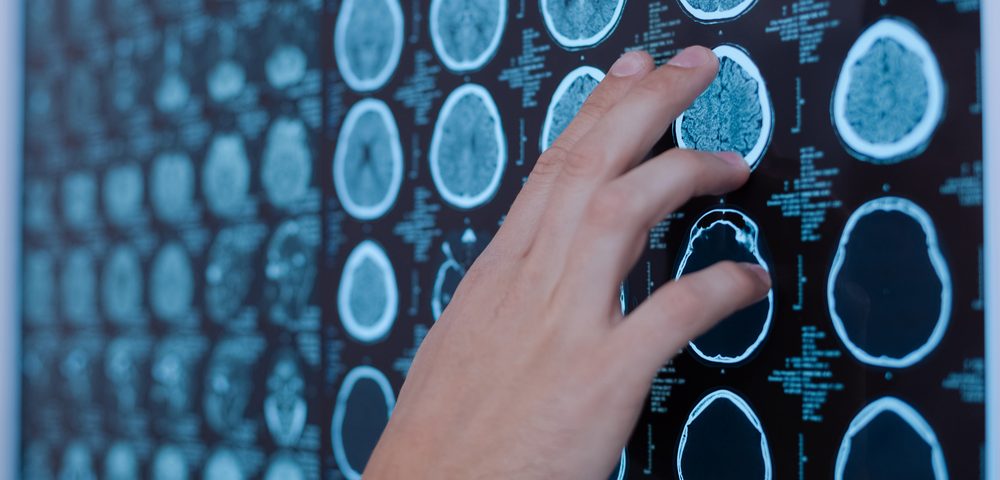 Diabetes, Hypertension, Smoking Linked with Brain Shrinkage in MS Patients Diabetes, Hypertension, Smoking Linked with Brain Shrinkage in MS Patients