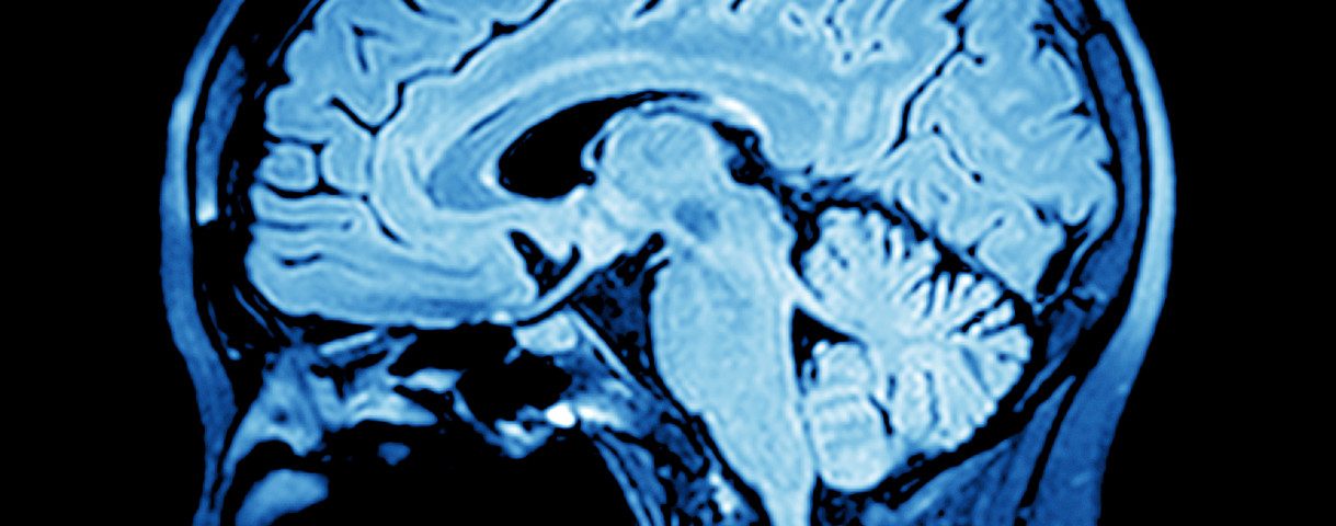 #ACTRIMS2019 – RRMS Conversion to SPMS Is Preceded by Spinal Cord Atrophy #ACTRIMS2019 – RRMS Conversion to SPMS Is Preceded by Spinal Cord Atrophy