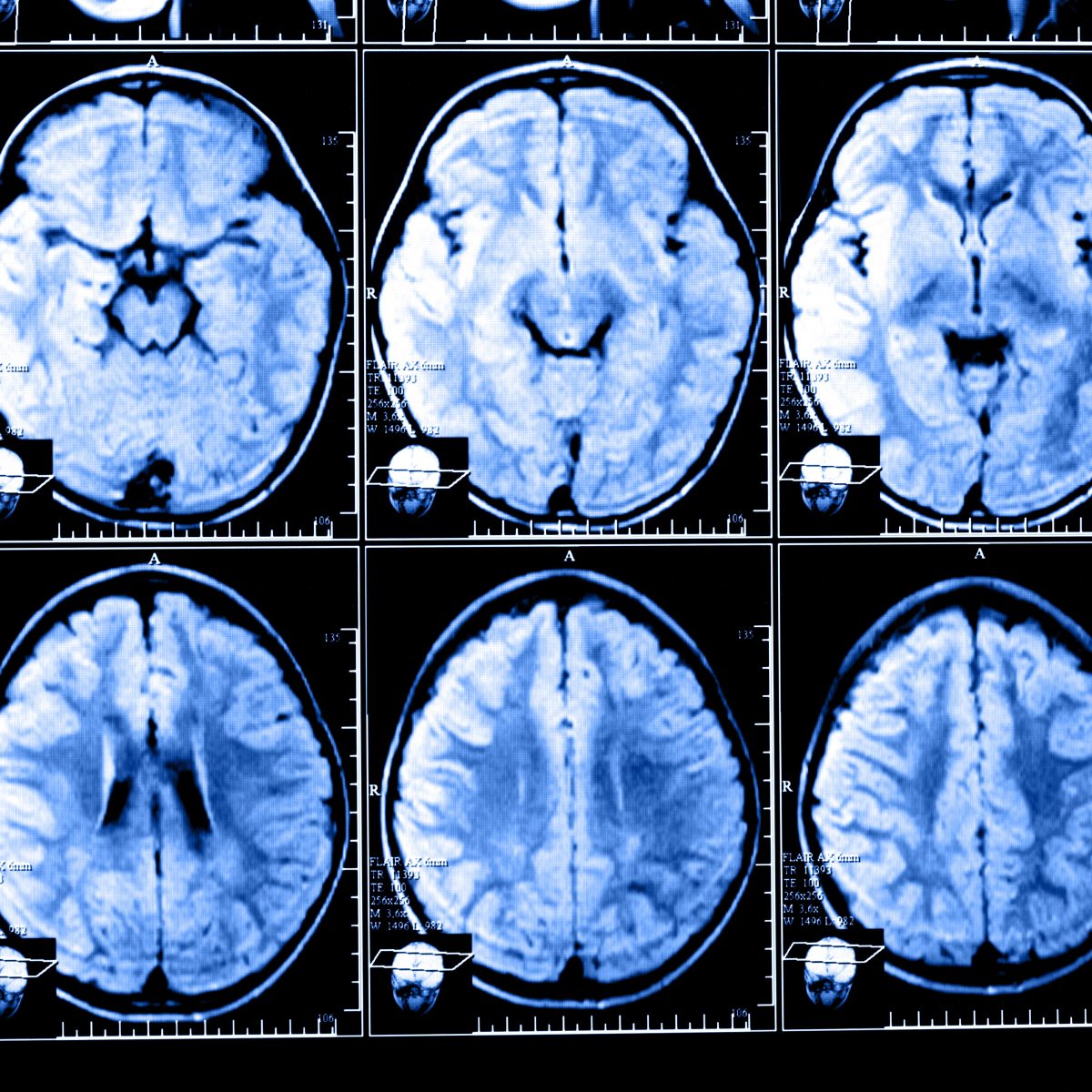 QyScore Brain Imaging Software Earns FDA 510(k) Clearance