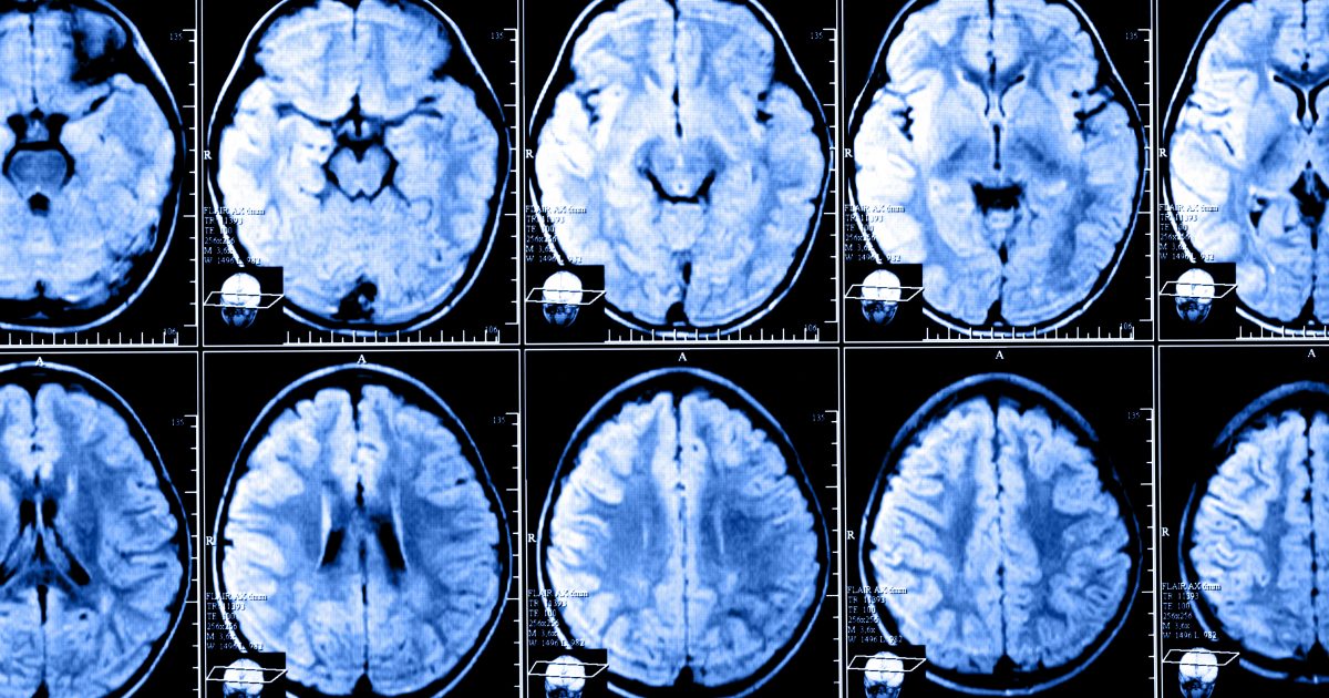 Novel MRI Marker Can Better Predict MS Progression, Study Says