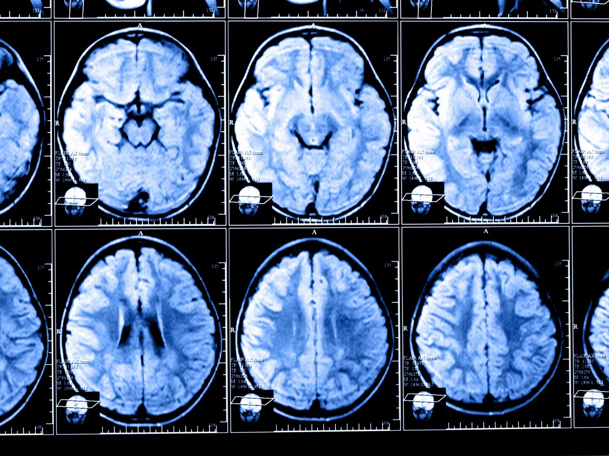 QyScore Brain Imaging Software Earns FDA 510(k) Clearance