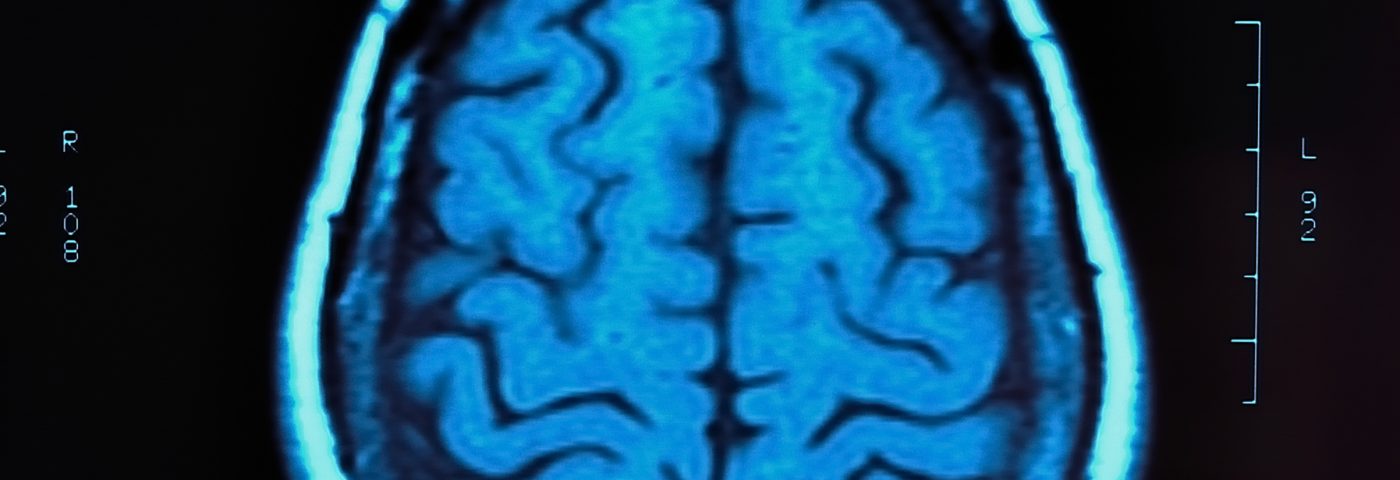 New PET Scan Radiotracer May Help Identify Early Signs of MS Progression, Study Reports New PET Scan Radiotracer May Help Identify Early Signs of MS Progression, Study Reports