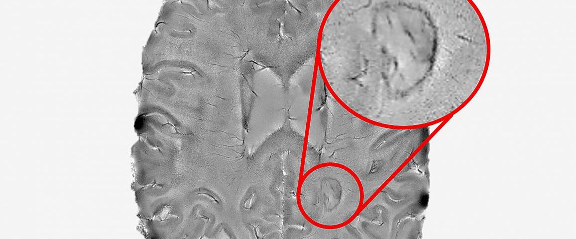 Dark Rimmed Brain Lesions May Be Signal of Aggressive Disease, NIH Study Says Dark Rimmed Brain Lesions May Be Signal of Aggressive Disease, NIH Study Says