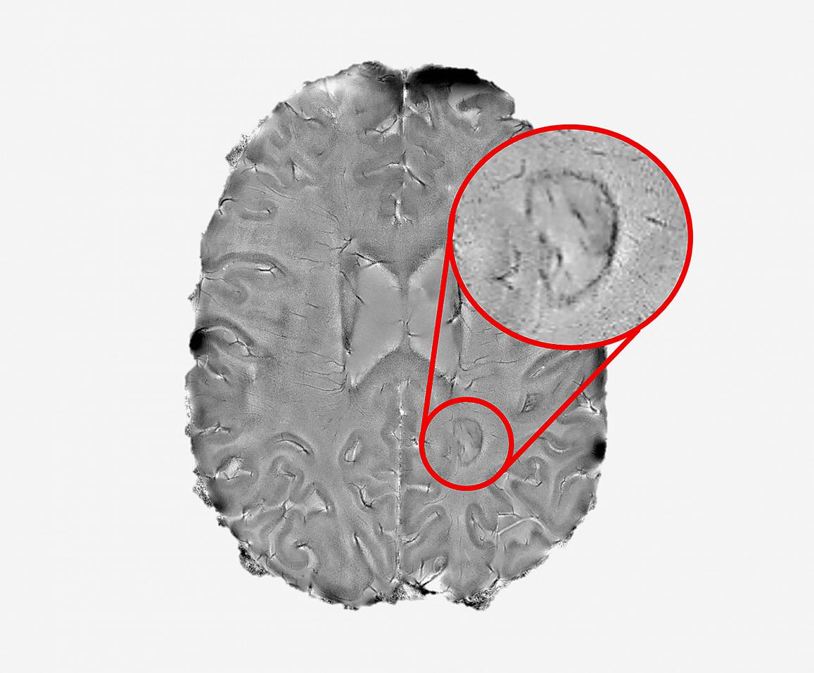 dark-rimmed brain lesions
