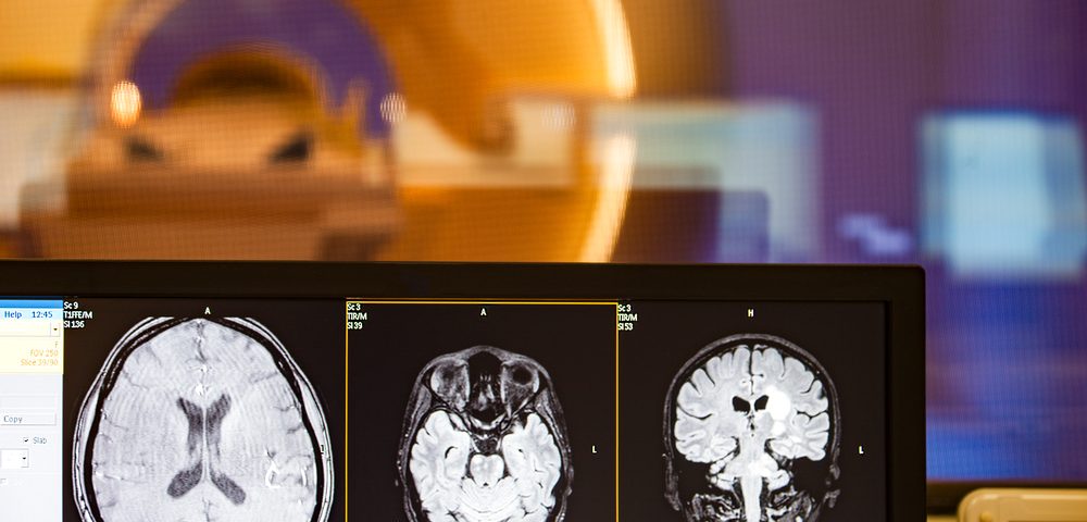 Central Vein Sign Maintains Potential as MS Diagnostic Marker, European Study Shows Central Vein Sign Maintains Potential as MS Diagnostic Marker, European Study Shows