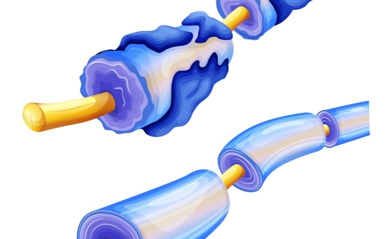 New Mechanism Boosting Myelin Regeneration May Ease MS Symptoms, Mouse Study Shows New Mechanism Boosting Myelin Regeneration May Ease MS Symptoms, Mouse Study Shows