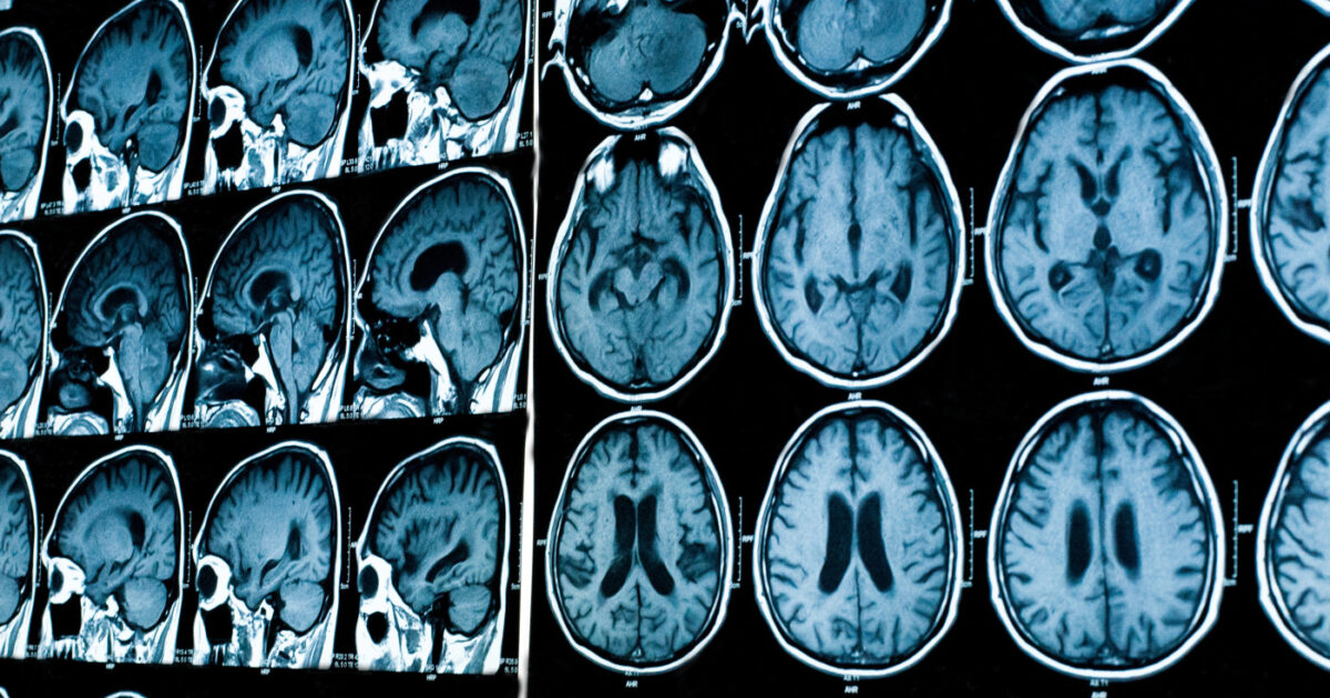 MS Has 3 Distinct Groups, Says Study of MRI Brain Patterns Using AI