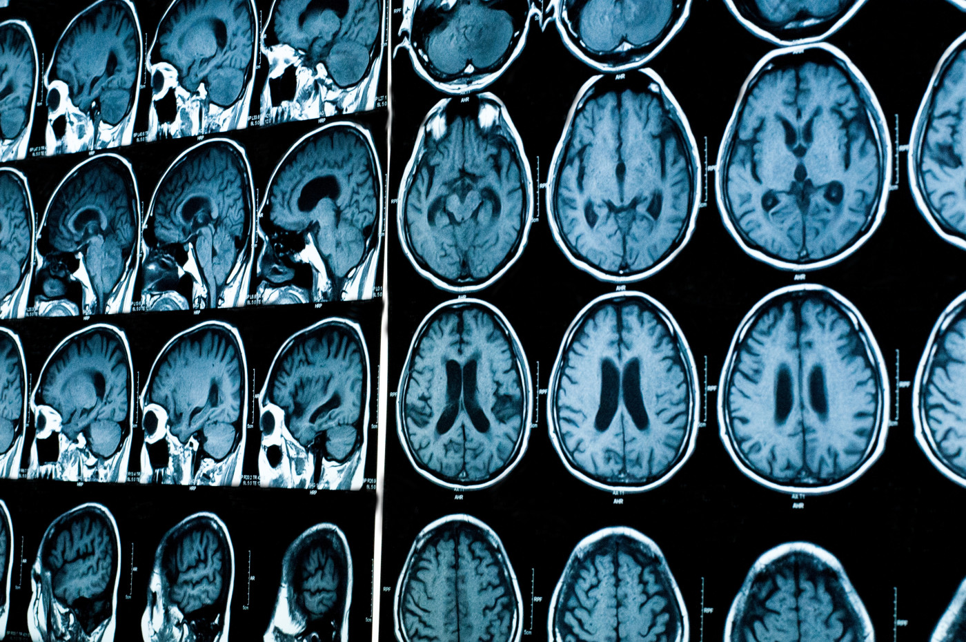 MS subtypes study