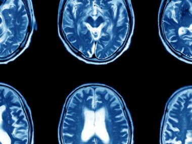inflammatory protein SIGLEC1
