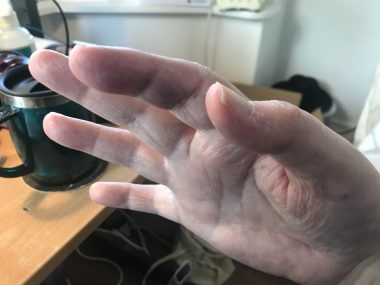 THC and MS | Multiple Sclerosis News Today | John stretches out his fingers into a flattened hand position to demonstrate his flexibility after taking THC