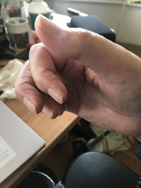 THC and MS | Multiple Sclerosis News Today | John's fingers on his right hand are curled due to MS spasticity after he's taken no medication