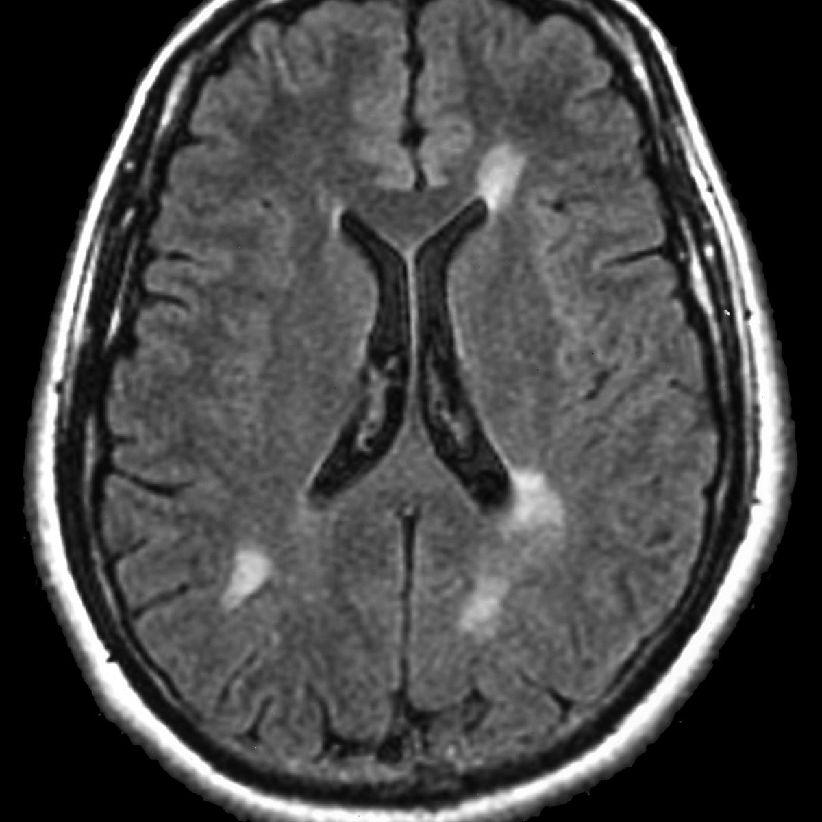 MS Brain Lesions and Their Effects