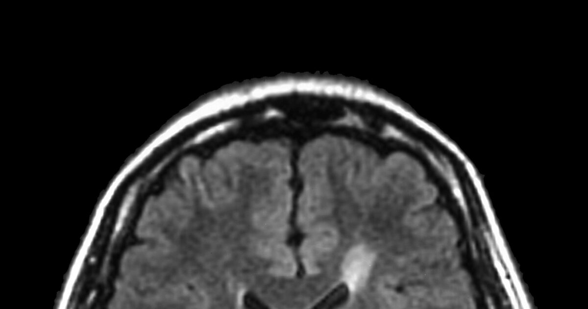 MS Brain Lesions and Their Effects