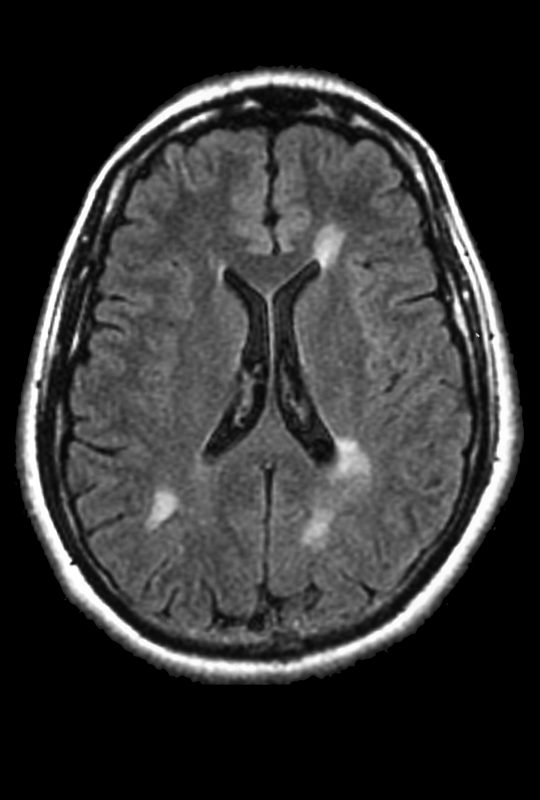 MS lesions, MRI scan | Multiple Sclerosis News Today | image of a brain MRI showing white spots that indicate MS lesions