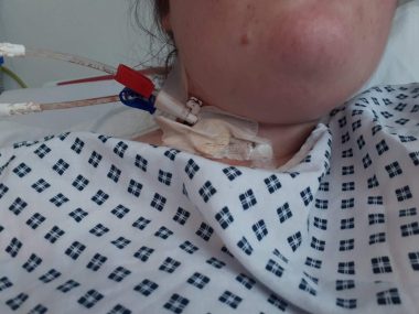 plasmapheresis | Multiple Sclerosis News Today | a close-up photograph of a tube connected to Beth's bandaged neck 
