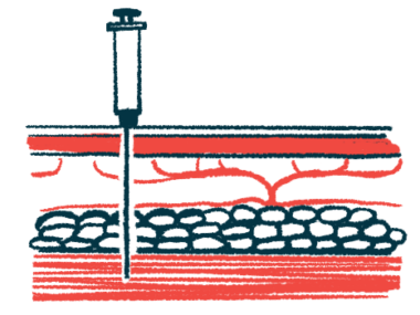overactive bladder multiple sclerosis | Multiple Sclerosis News Today | intramuscular illustration