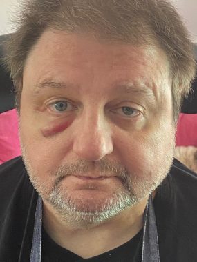 multiple sclerosis falls | Multiple Sclerosis News Today | A closeup of John's face shows a nasty shiner under his right eye