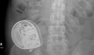 intrathecal baclofen pump | Multiple Sclerosis News Today | photo of an X-ray, with spine at center and a device at left