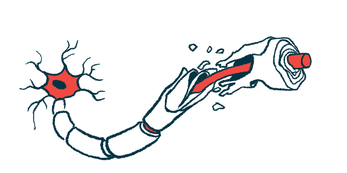 An illustration of damaged myelin along a nerve cell fiber.