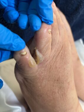 A close-up of a foot shows bullous pemphigoid on two toes. A hand with blue rubber gloves on separates two toes to show the blistery patches.